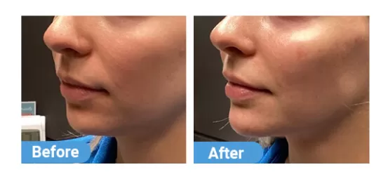 before after