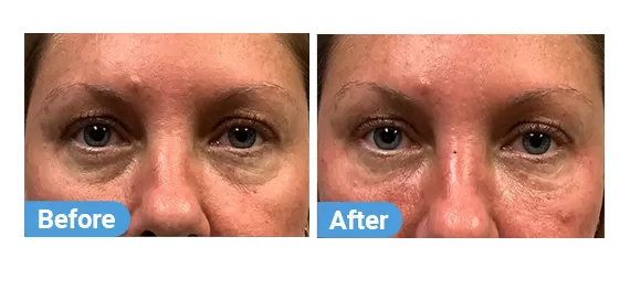 tear-trough-filler-4